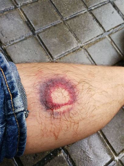 Uno de los heridos por la utilización de pelotas de goma. Imagen: @centre_IRIDIA 