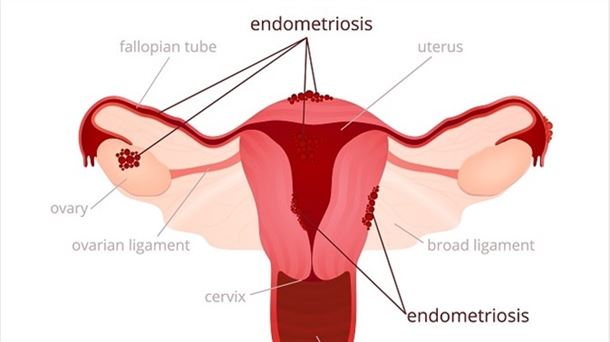 Endometriosis: Enfermedad silenciosa 