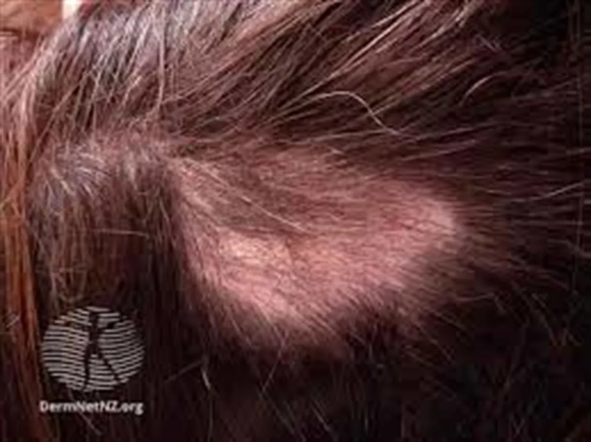 Alopecia: causas, tipologías y tratamientos efectivos