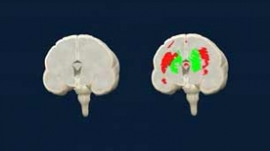 BCBL: 'Saber más de 2 idiomas, una barrera contra el Alzheimer'