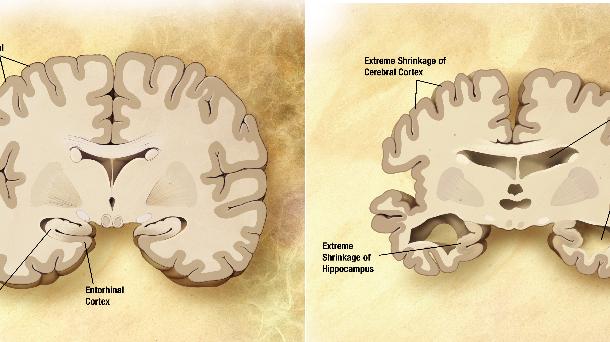 Alzheimer: cuando el recuerdo se convierte en olvido.                 