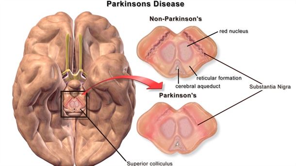 Burua trebatu, Parkinsonari balazta jartzeko