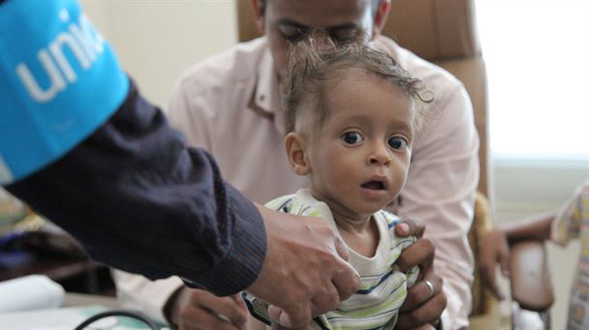 Un niño es atendido en Yemen