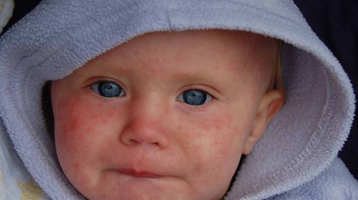 Niño enfermo de sarampión