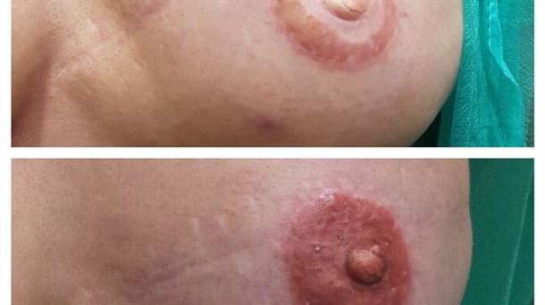 Reconstrucción con tatuaje de pezón y areola en 3D tras una masectomía