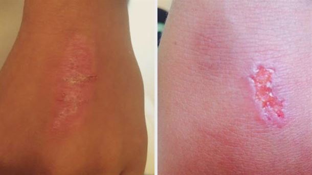 Un colegio de Bilbao detecta un peligroso juego viral que consiste en lesionarse