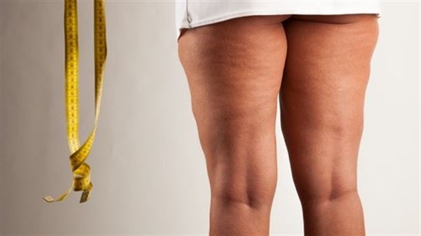 Lipedema, enfermedad del tejido adiposo