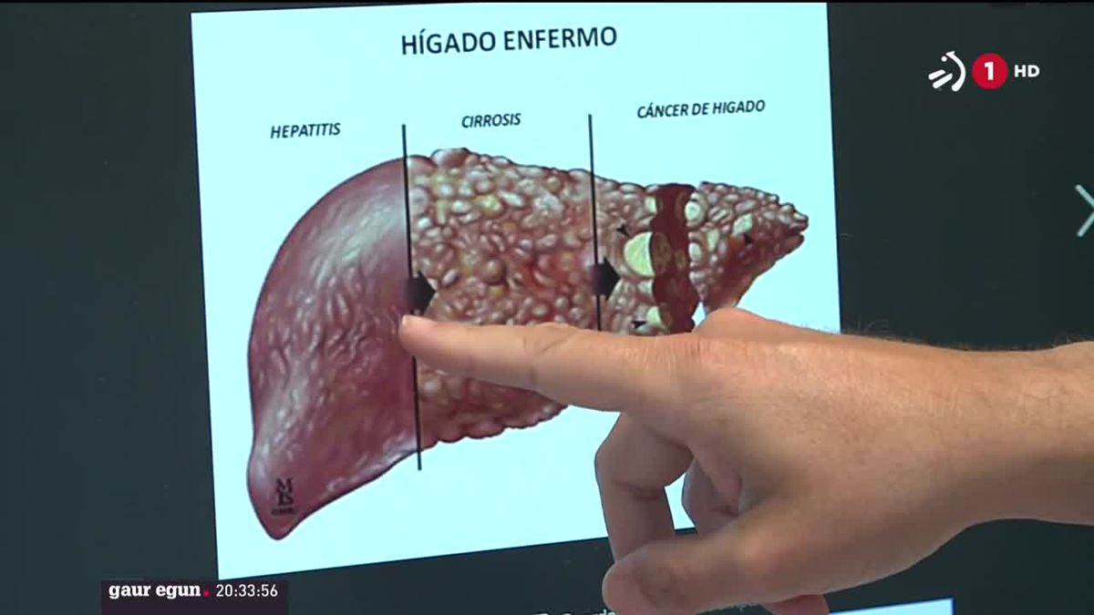 C Hepatitisa. ETBren bideo batetik ateratako irudia.