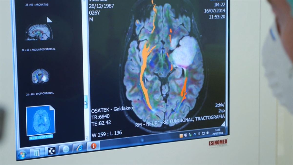 Tumores cerebrales. Imagen obtenida de un vídeo de ETB.