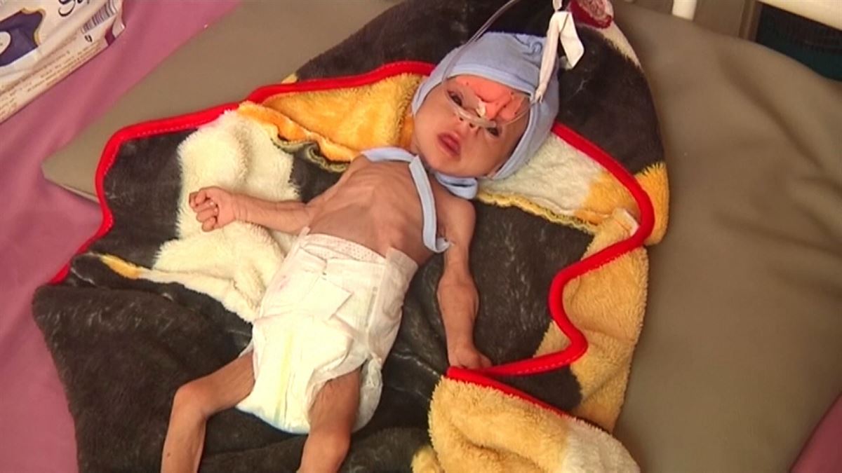 Riesgo de hambruna en Yemen. Imagen: Agencias