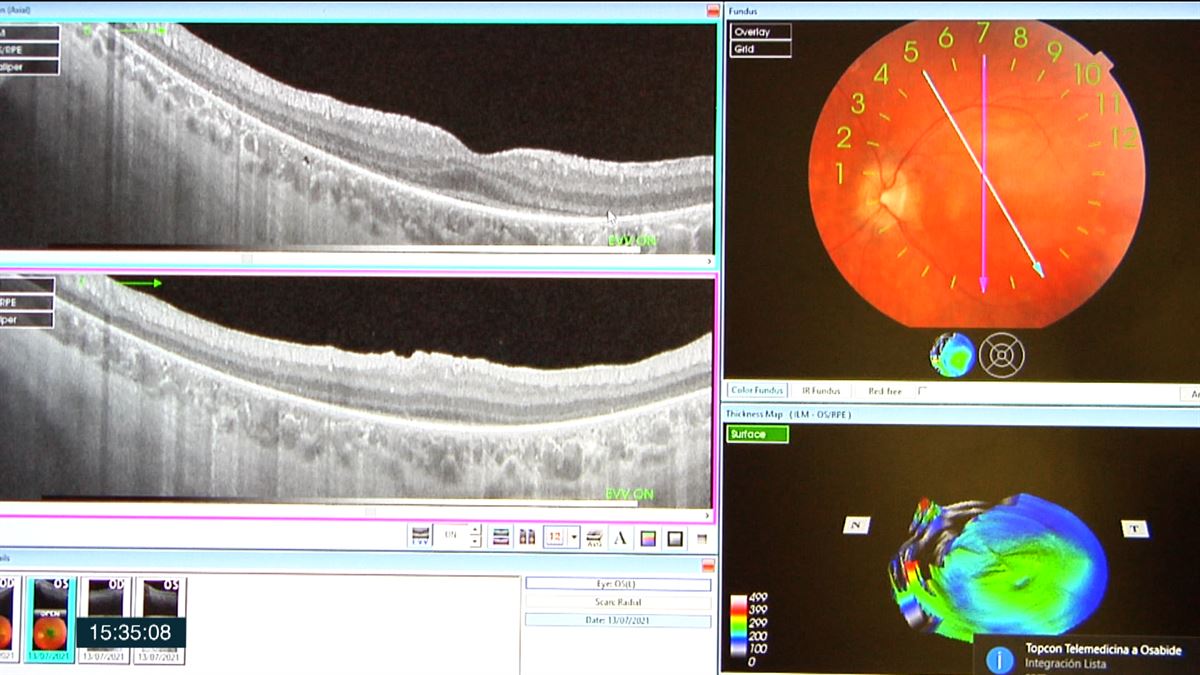 El Hospital de Donostia, referente en el tratamiento de la distrofia de retina