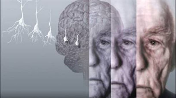 Alzheimer: En Álava 6.000 personas padecen esta enfermedad