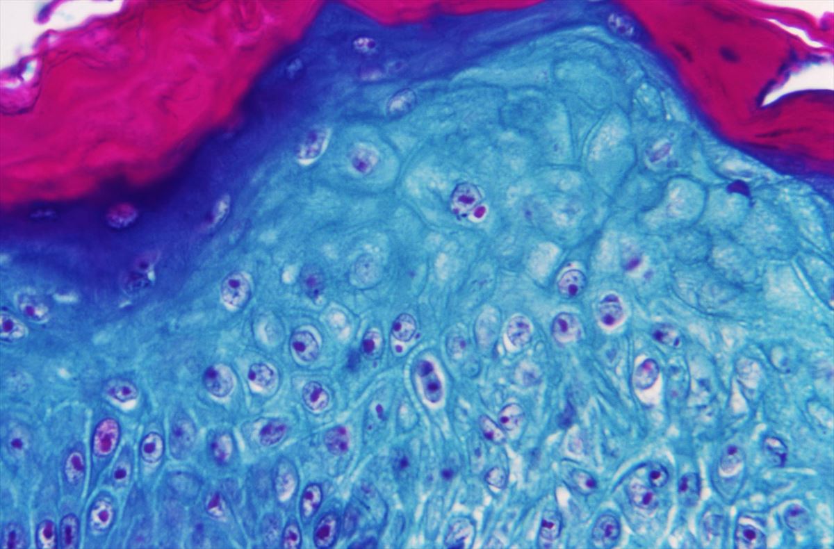 Imagen ampliada con un microscopio de una muestra de piel infectada con el virus. Foto: EFE