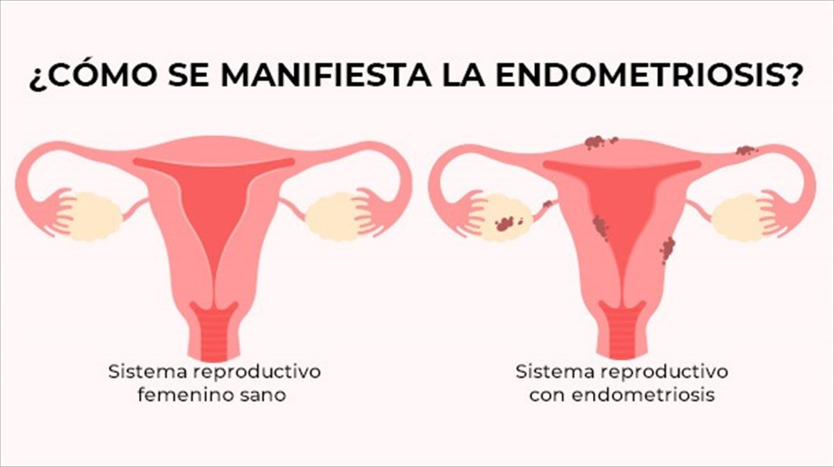 ¿Cómo se manifiesta la endometriosis?