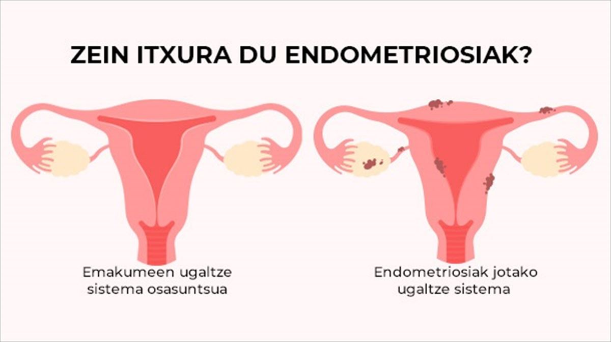 Zein itxura du endometrisosiak?