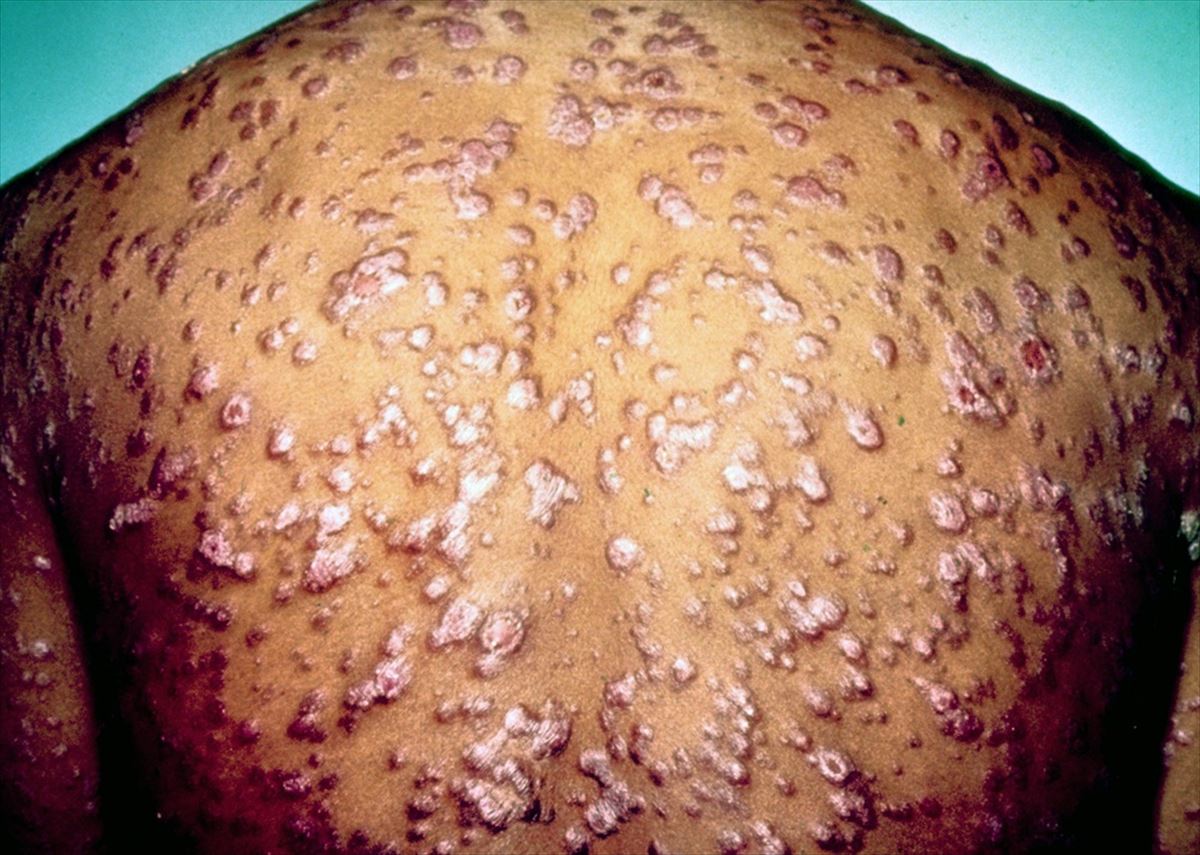 Un hombre con una infección de sifilis. Imagen: Wikimedia Commons
