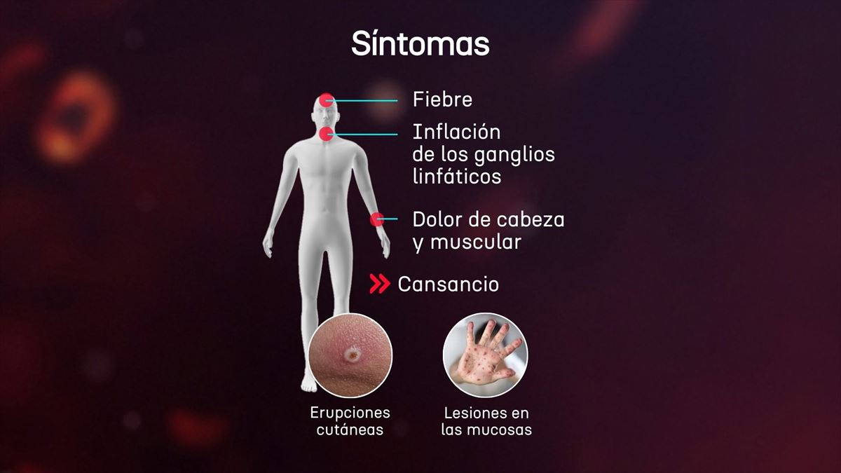 Sntomas del mpox. Imagen: EITB