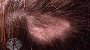 Alopecia: causas, tipologías y tratamientos efectivos