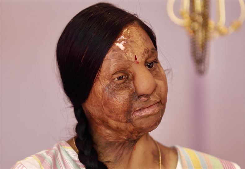 8M Bangalore, India. Ratna, de 31 años, fue rociada con ácido. EFE. 