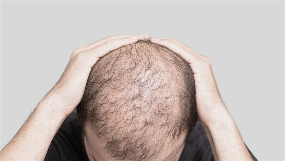 Alopezia duen gizon baten buruaren irudia
