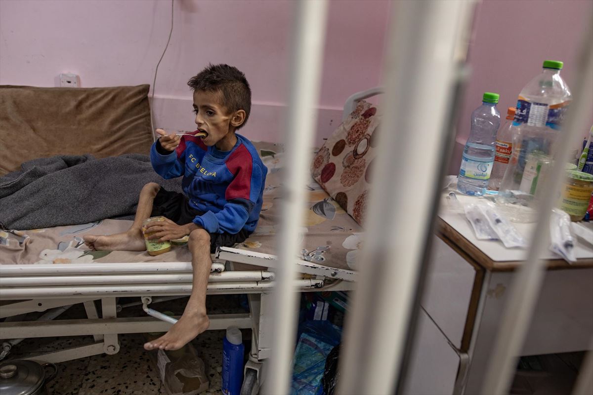 Osama Al-Raqab, muturreko malnutrizioa duen 5 urteko mutiko gazatarra. Argazkia: EFE