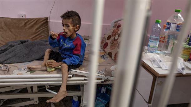Osama Al-Raqab, un niño gazatí de 5 años con malnutrición extrema. Foto: EFE