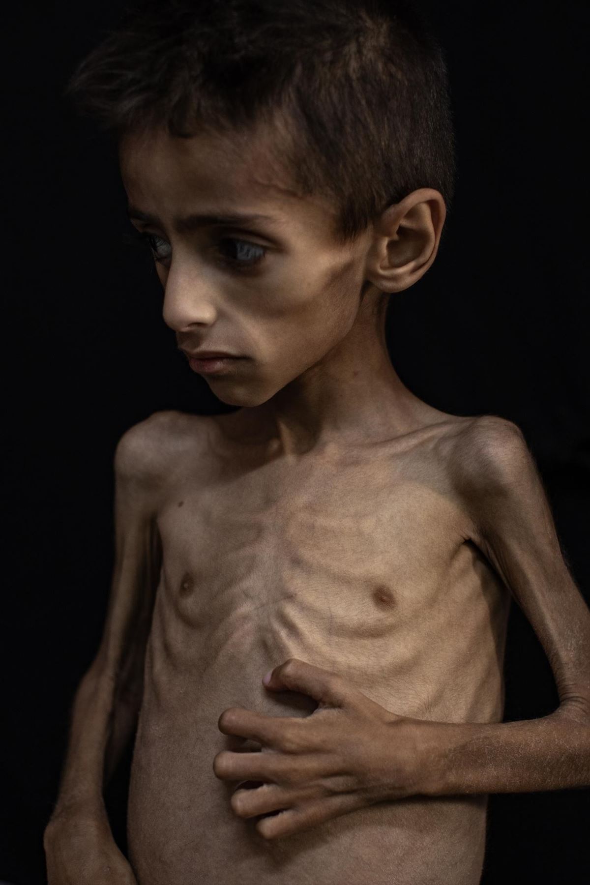 Osama Al-Raqab, muturreko malnutrizioa duen 5 urteko mutiko gazatarra. Argazkia: EFE