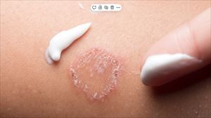 ¿Qué es la tiña y cómo se trata? Claves para entender esta infección común de la piel